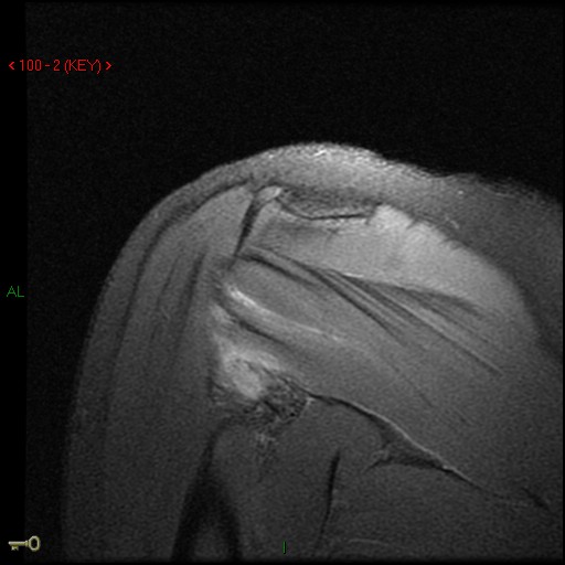 Figure 3 for case Posterior dislocation, posterior capsular avulsion from humerus   teres minor tear